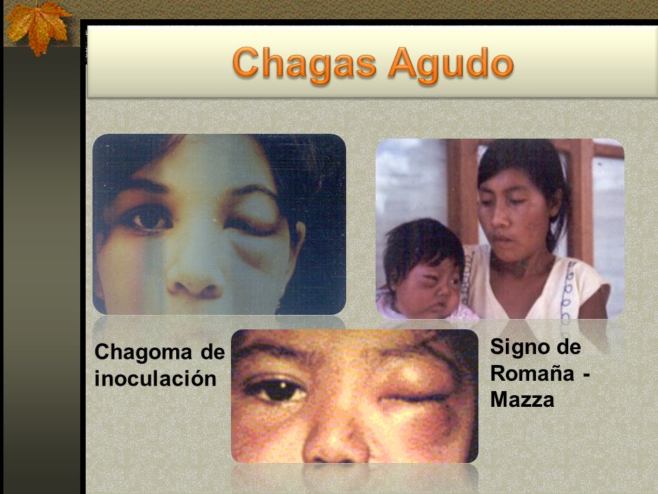 Chagas Agudo Signo de Romaña - Mazza Chagoma de inoculación