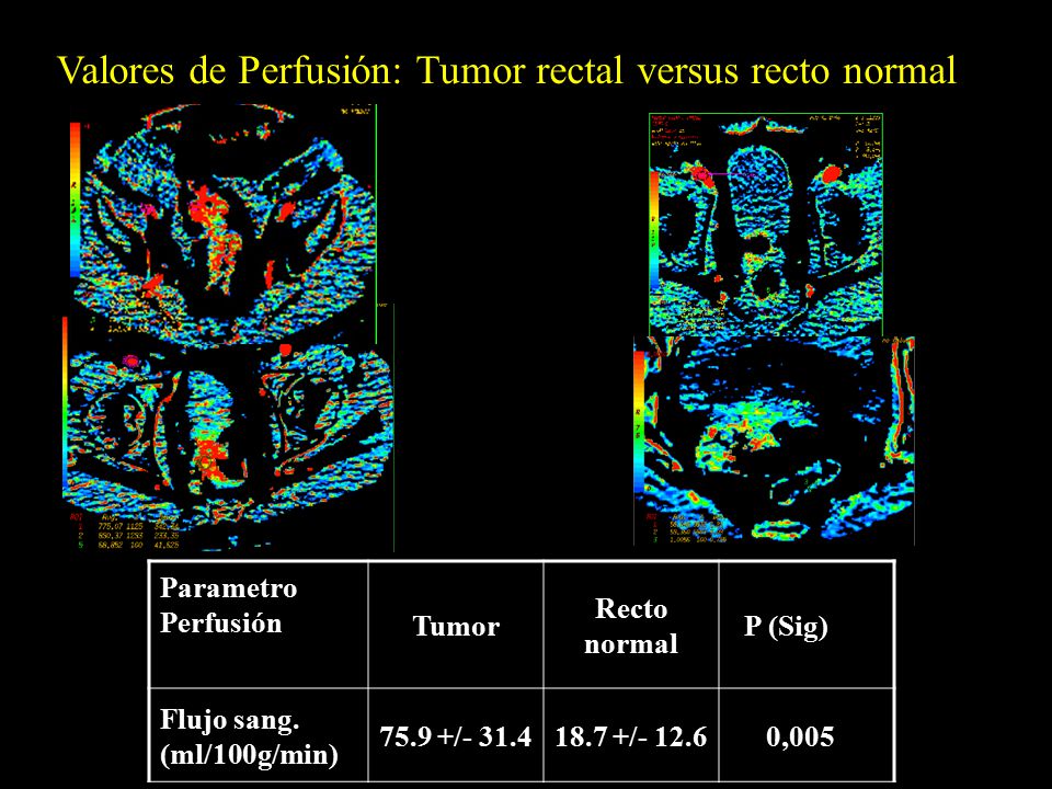 Valores de Perfusión: Tumor rectal versus recto normal