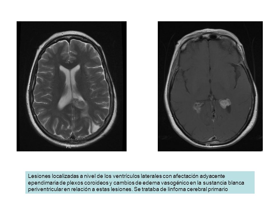 Lesiones localizadas a nivel de los ventrículos laterales con afectación adyacente ependimaria de plexos coroideos y cambios de edema vasogénico en la sustancia blanca periventricular en relación a estas lesiones.