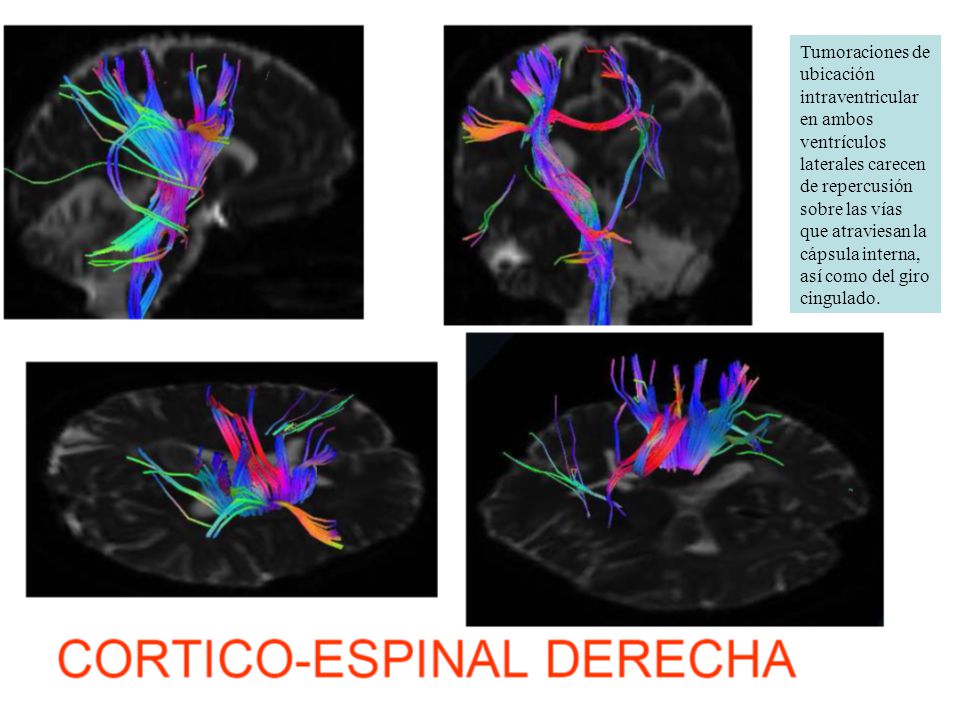 Tumoraciones de ubicación intraventricular en ambos ventrículos laterales carecen de repercusión sobre las vías que atraviesan la cápsula interna, así como del giro cingulado.