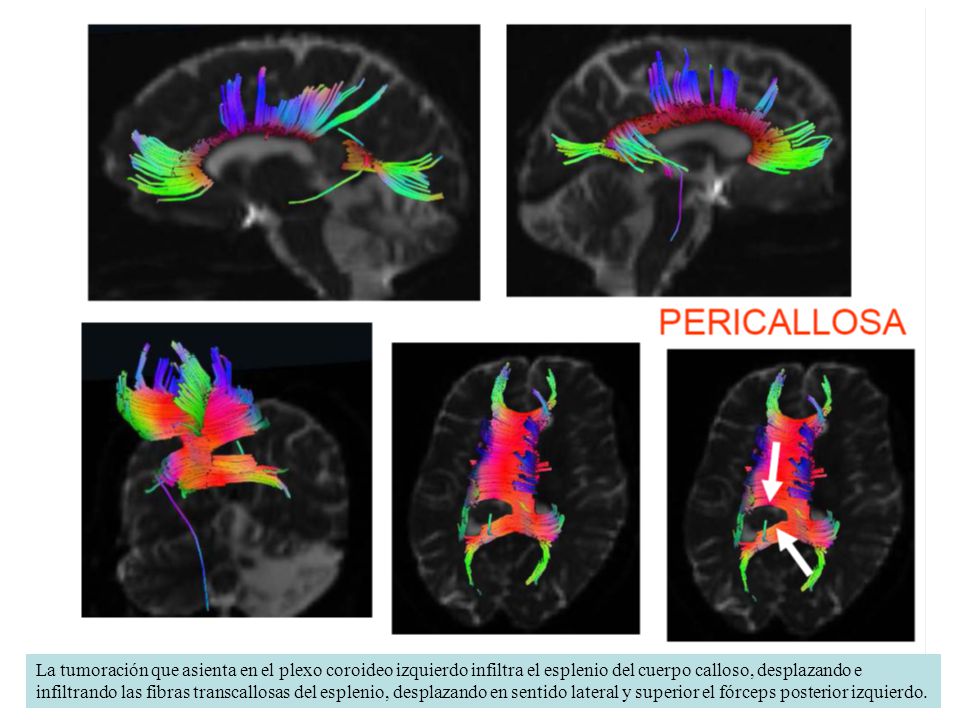 La tumoración que asienta en el plexo coroideo izquierdo infiltra el esplenio del cuerpo calloso, desplazando e infiltrando las fibras transcallosas del esplenio, desplazando en sentido lateral y superior el fórceps posterior izquierdo.