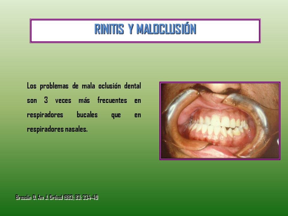 RINITIS Y MALOCLUSIÓN Los problemas de mala oclusión dental son 3 veces más frecuentes en respiradores bucales que en respiradores nasales.