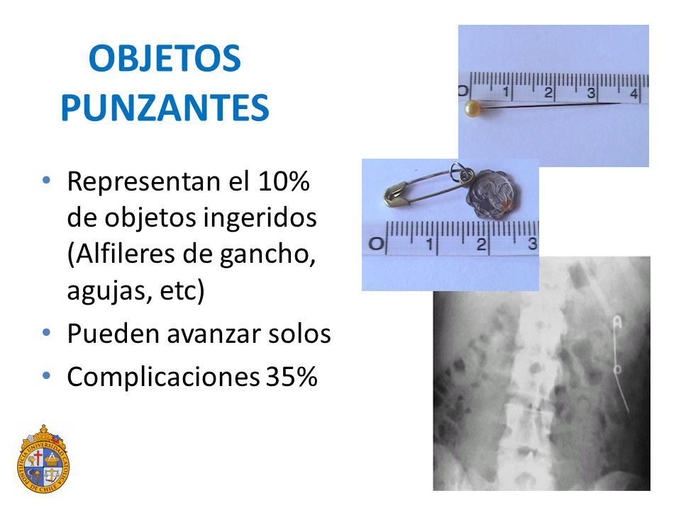 OBJETOS PUNZANTES Representan el 10% de objetos ingeridos (Alfileres de gancho, agujas, etc) Pueden avanzar solos.