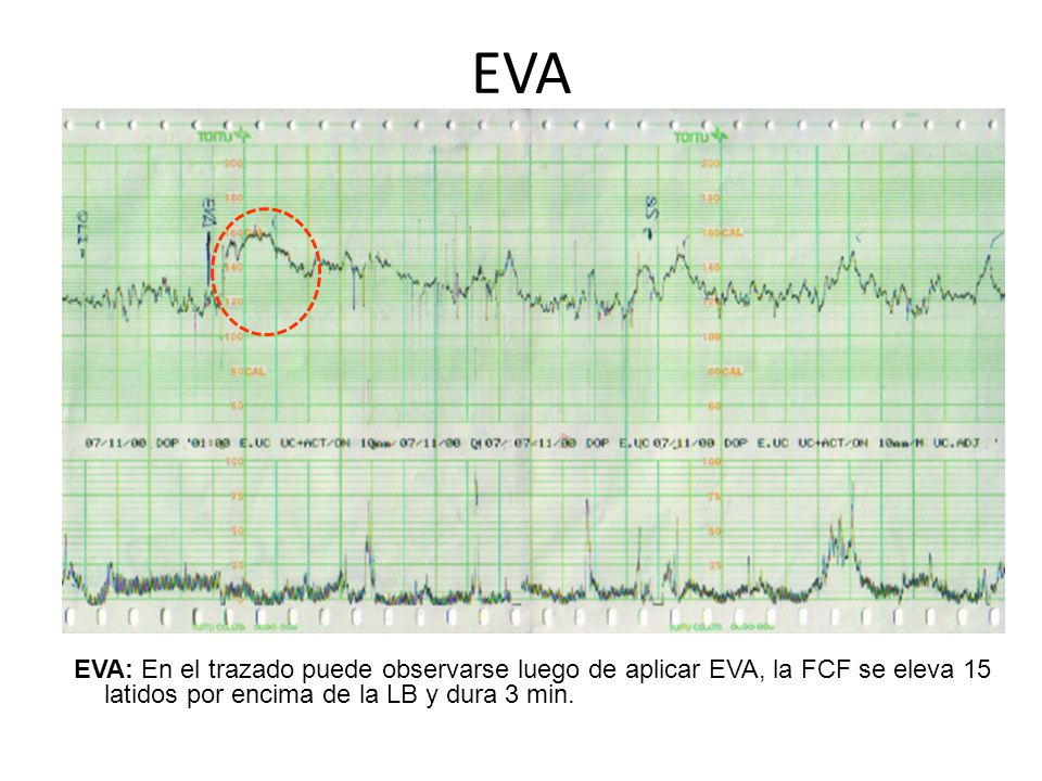 EVA EVA: En el trazado puede observarse luego de aplicar EVA, la FCF se eleva 15 latidos por encima de la LB y dura 3 min.