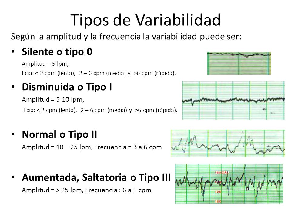 Tipos de Variabilidad Silente o tipo 0 Disminuida o Tipo I
