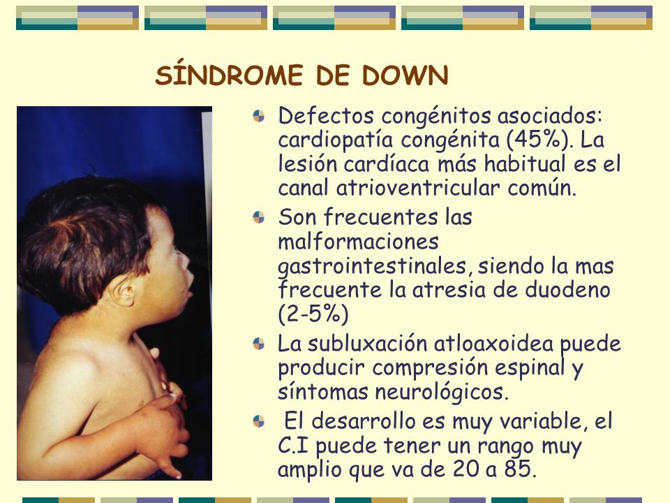 SÍNDROME DE DOWN Defectos congénitos asociados: cardiopatía congénita (45%). La lesión cardíaca más habitual es el canal atrioventricular común.