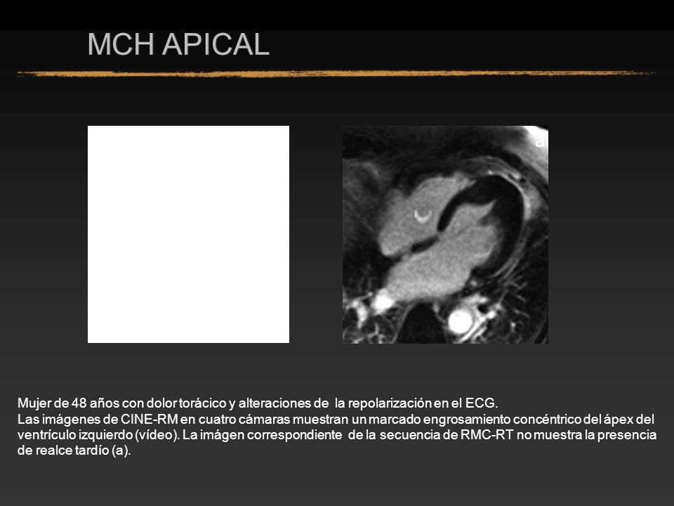 MCH APICAL a. Mujer de 48 años con dolor torácico y alteraciones de la repolarización en el ECG.
