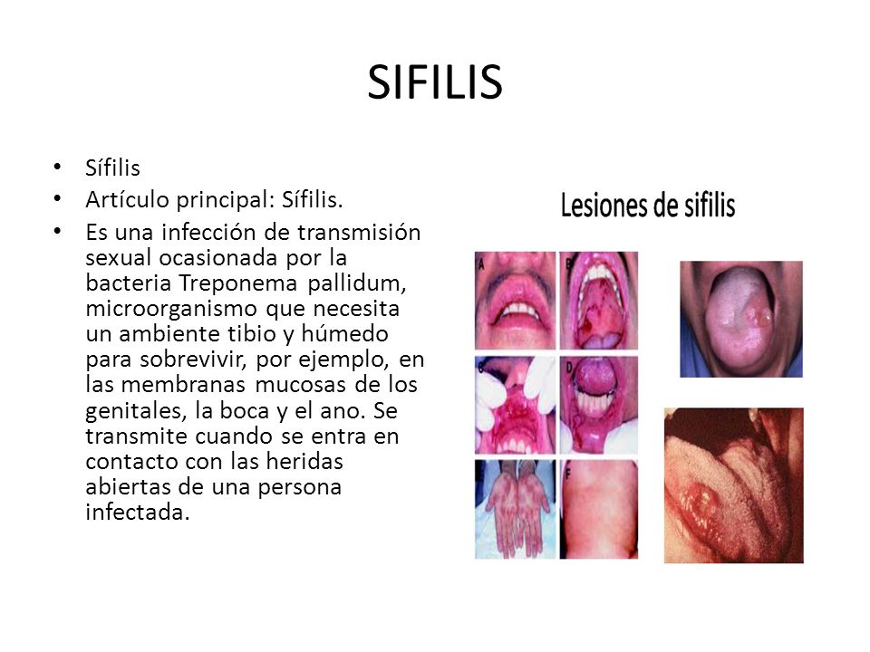 SIFILIS Sífilis Artículo principal: Sífilis.