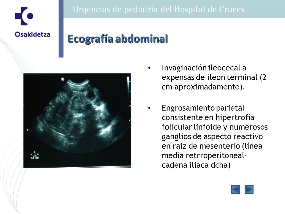 Ecografía abdominal Invaginación ileocecal a expensas de íleon terminal (2 cm aproximadamente).