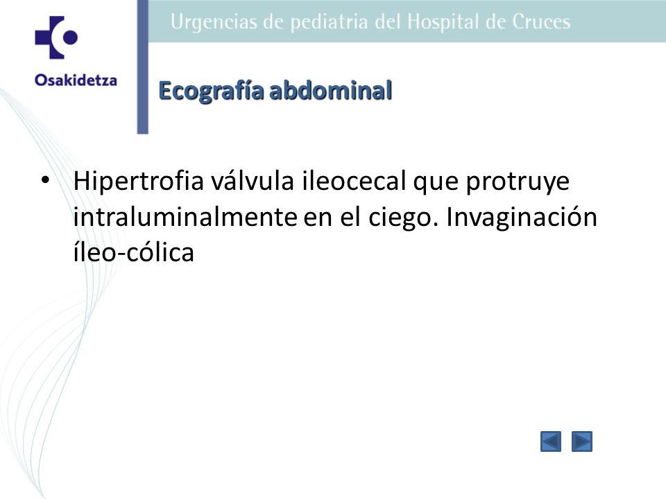 Ecografía abdominal Hipertrofia válvula ileocecal que protruye intraluminalmente en el ciego.