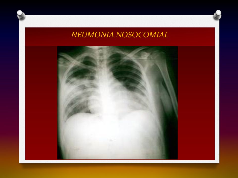NEUMONIA NOSOCOMIAL