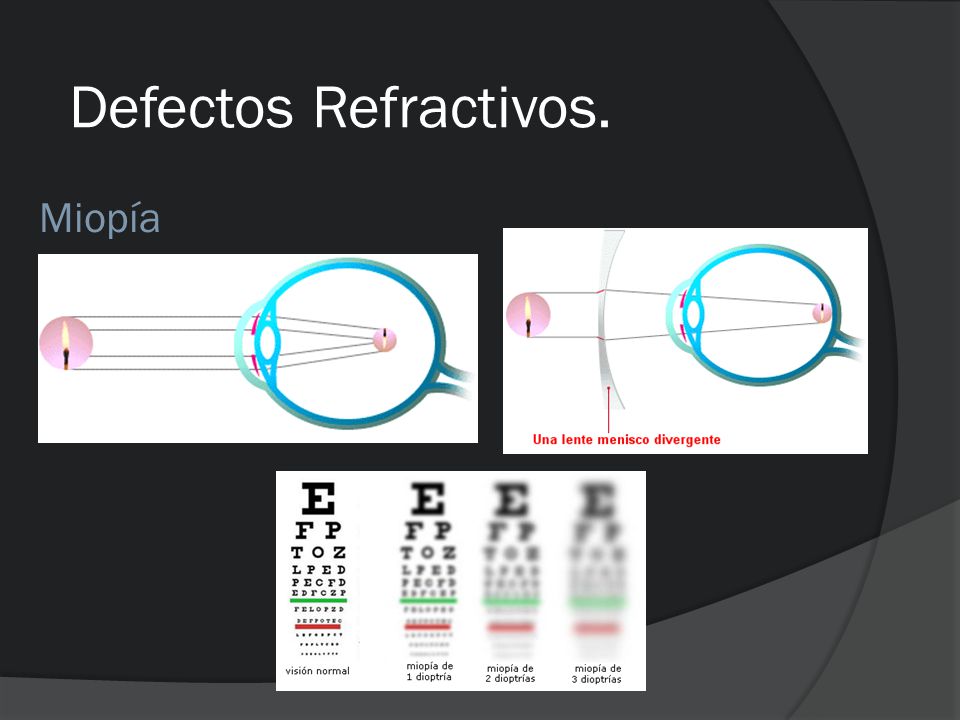 Defectos Refractivos. Miopía