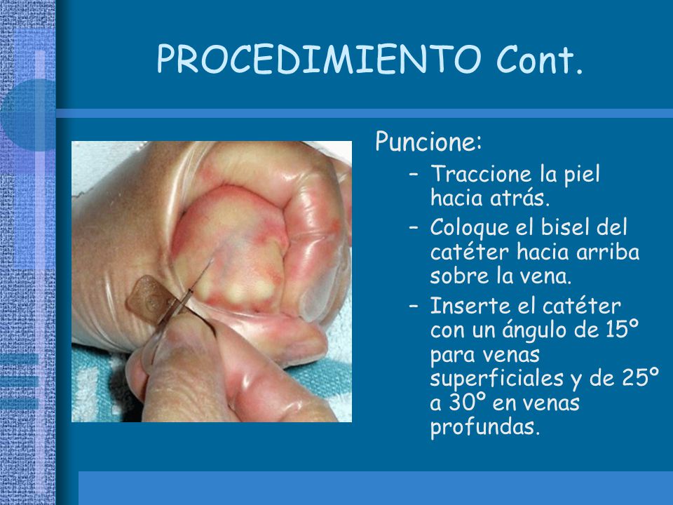 PROCEDIMIENTO Cont. Puncione: Traccione la piel hacia atrás.