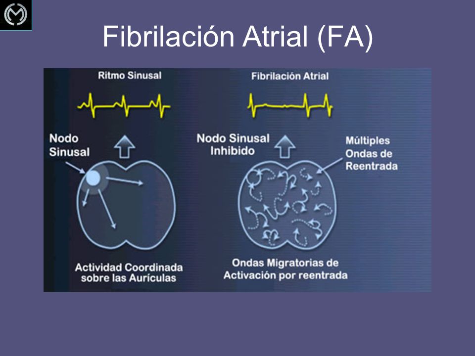 Fibrilación Atrial (FA)