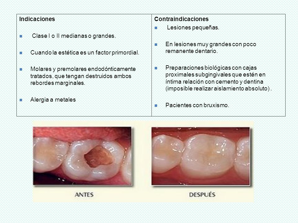 Indicaciones Clase I o II medianas o grandes. Cuando la estética es un factor primordial.