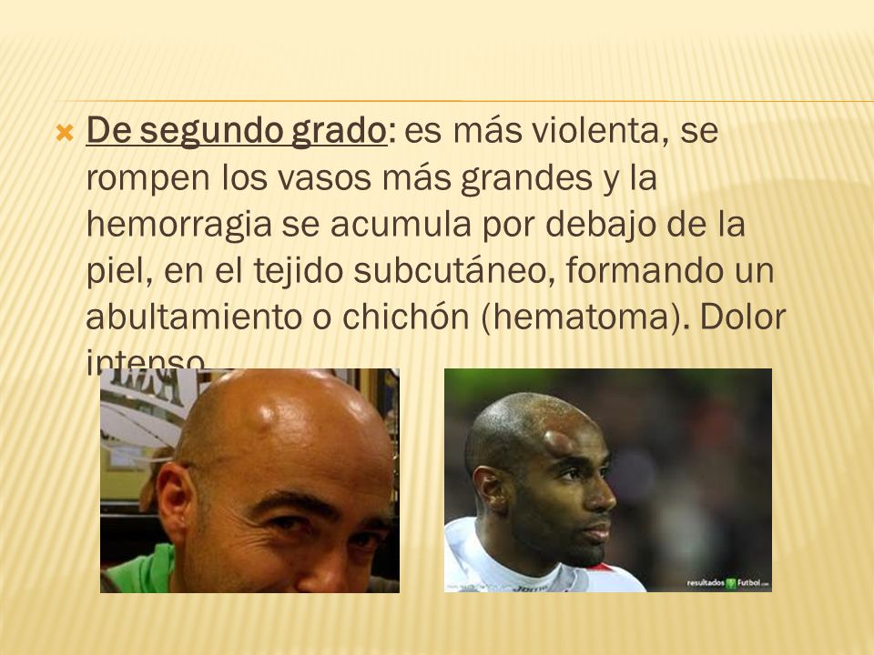 De segundo grado: es más violenta, se rompen los vasos más grandes y la hemorragia se acumula por debajo de la piel, en el tejido subcutáneo, formando un abultamiento o chichón (hematoma).