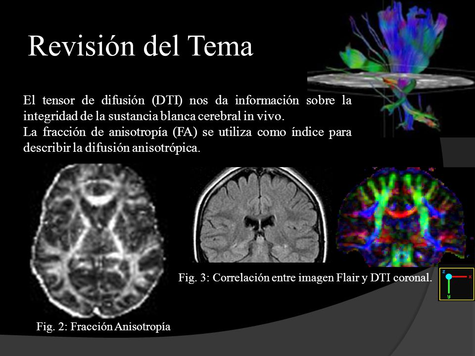 Revisión del Tema El tensor de difusión (DTI) nos da información sobre la integridad de la sustancia blanca cerebral in vivo.