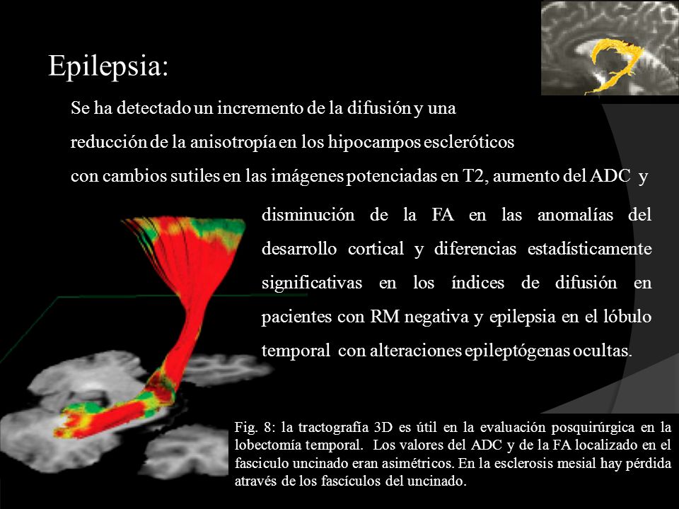 Epilepsia: Se ha detectado un incremento de la difusión y una