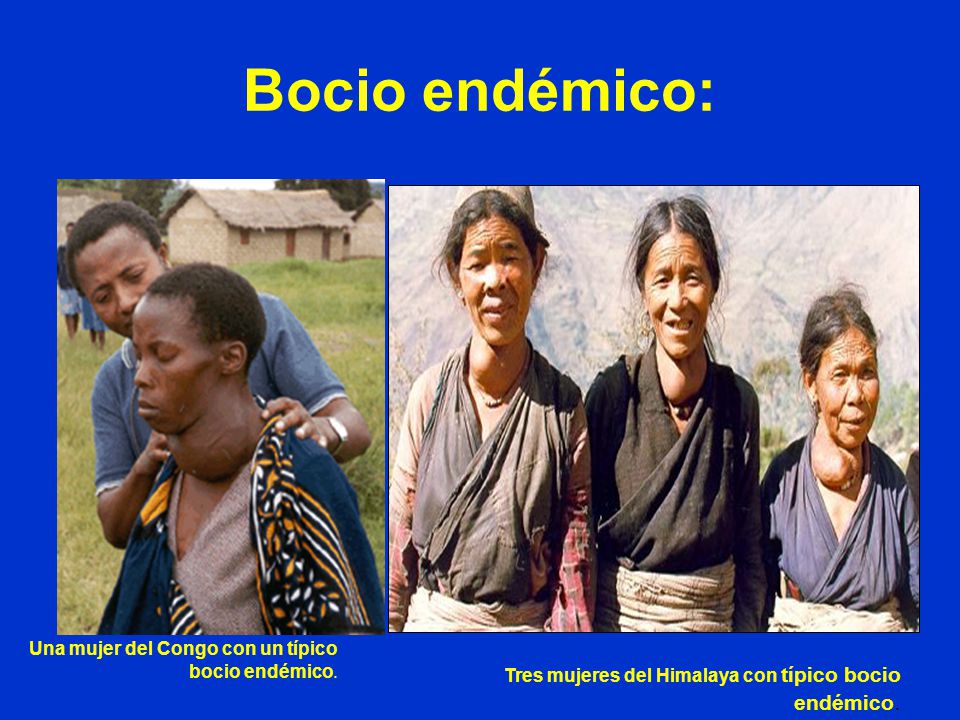 Bocio endémico: Una mujer del Congo con un típico bocio endémico.