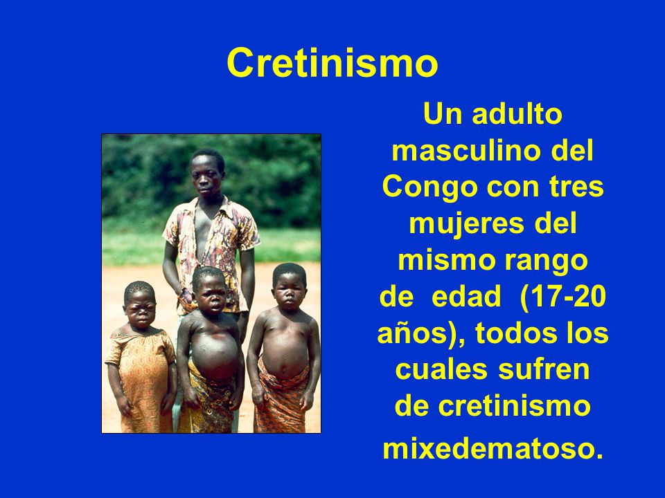 Cretinismo Un adulto masculino del Congo con tres mujeres del mismo rango de edad (17-20 años), todos los cuales sufren de cretinismo mixedematoso.