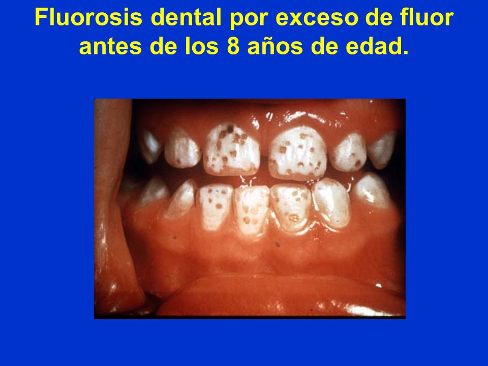 Fluorosis dental por exceso de fluor antes de los 8 años de edad.