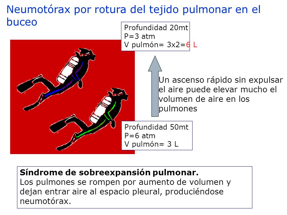 Neumotórax por rotura del tejido pulmonar en el buceo