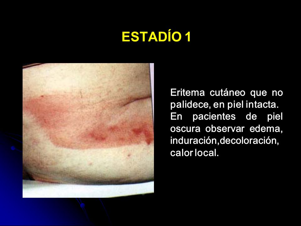 ESTADÍO 1 Eritema cutáneo que no palidece, en piel intacta.