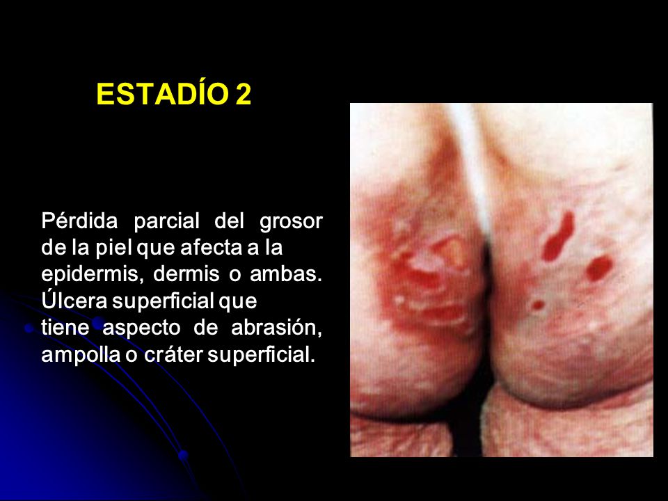 ESTADÍO 2 Pérdida parcial del grosor de la piel que afecta a la
