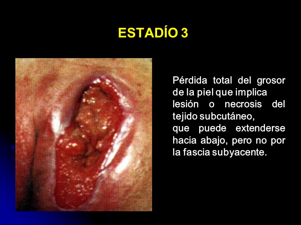 ESTADÍO 3 Pérdida total del grosor de la piel que implica