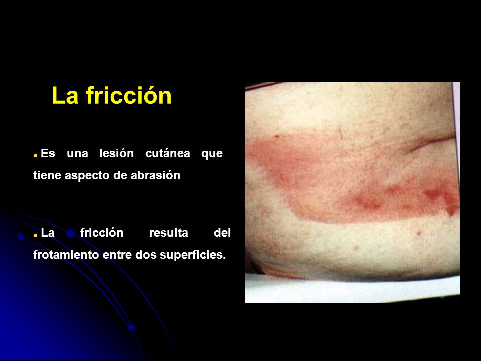 La fricción Es una lesión cutánea que tiene aspecto de abrasión