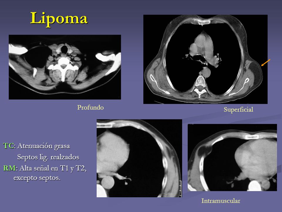 Lipoma Profundo. Superficial. TC: Atenuación grasa Septos lig. realzados RM: Alta señal en T1 y T2, excepto septos.