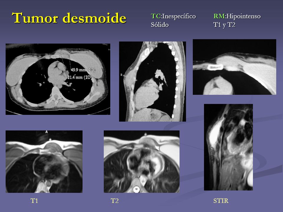 Tumor desmoide TC:Inespecífico Sólido RM:Hipointenso T1 y T2 T1 T2