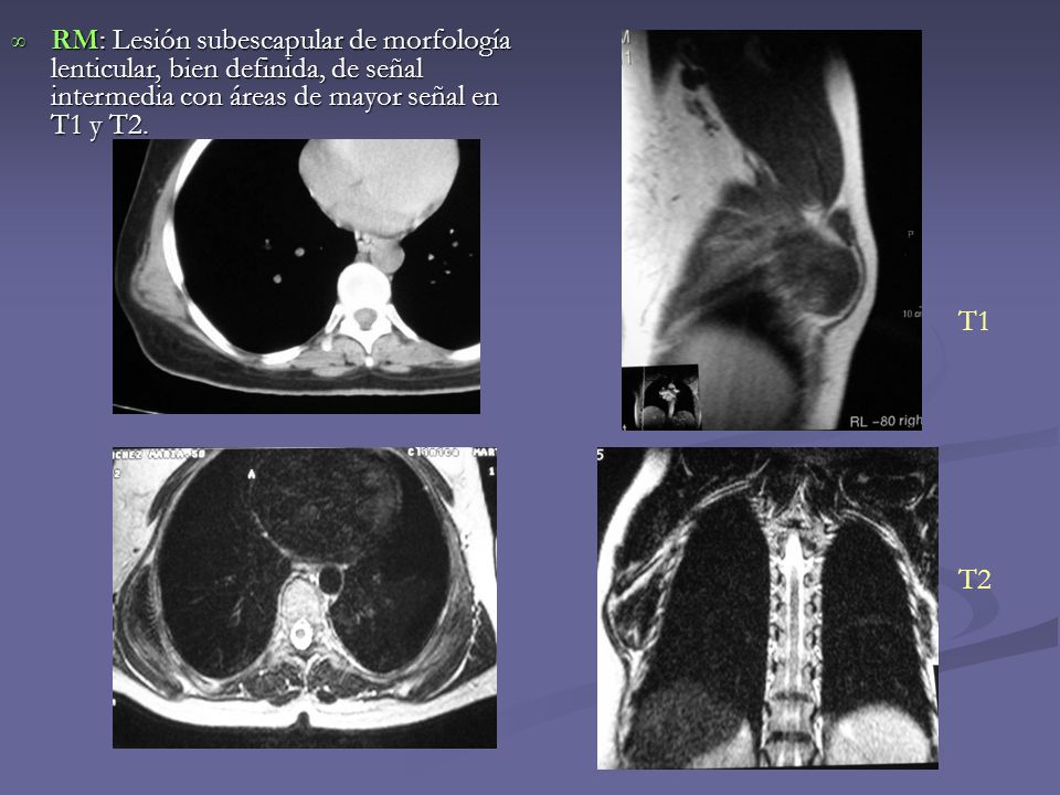 RM: Lesión subescapular de morfología lenticular, bien definida, de señal intermedia con áreas de mayor señal en T1 y T2.