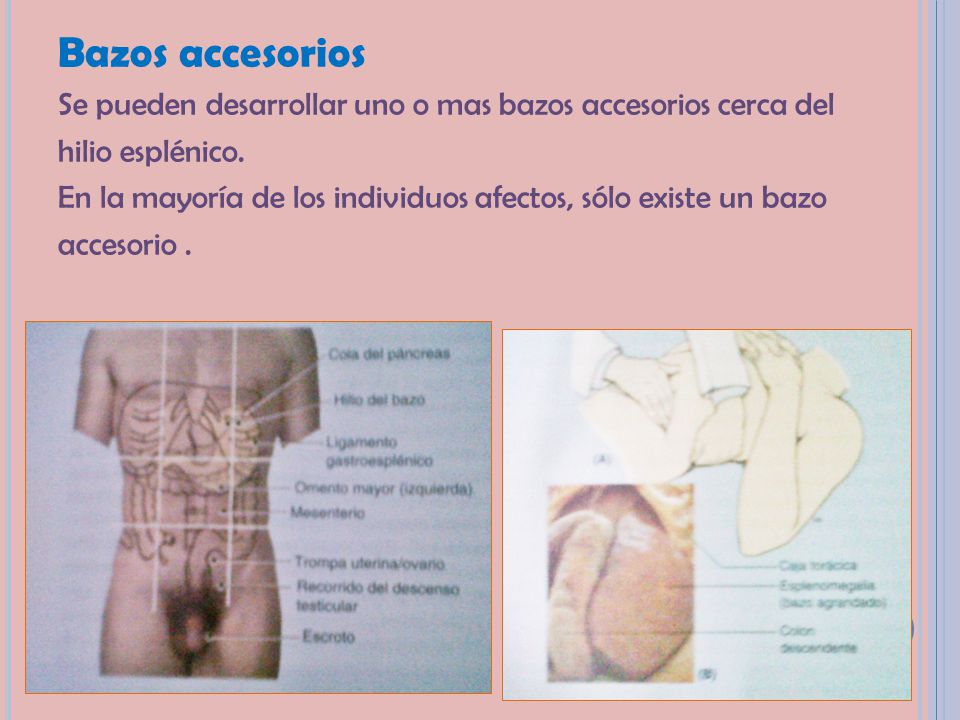 Bazos accesorios Se pueden desarrollar uno o mas bazos accesorios cerca del. hilio esplénico.