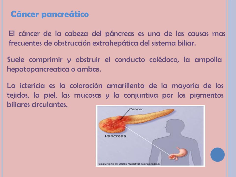 Cáncer pancreático El cáncer de la cabeza del páncreas es una de las causas mas frecuentes de obstrucción extrahepática del sistema biliar.