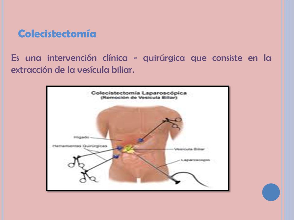 Colecistectomía Es una intervención clínica - quirúrgica que consiste en la extracción de la vesícula biliar.