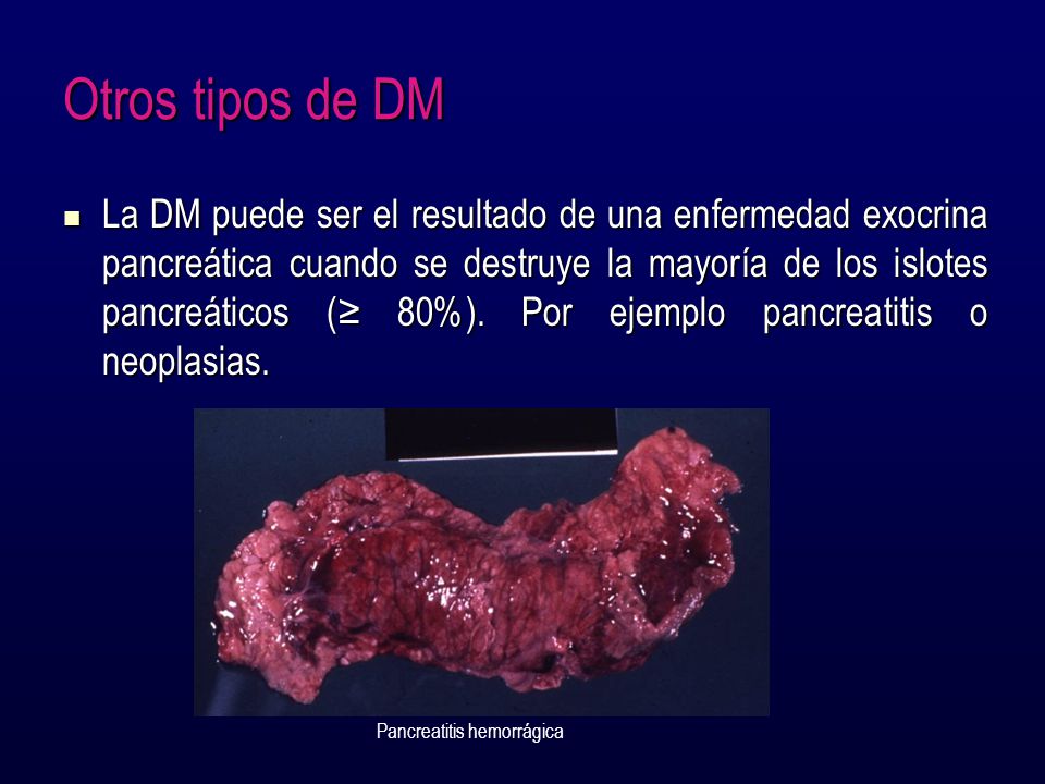 Otros tipos de DM