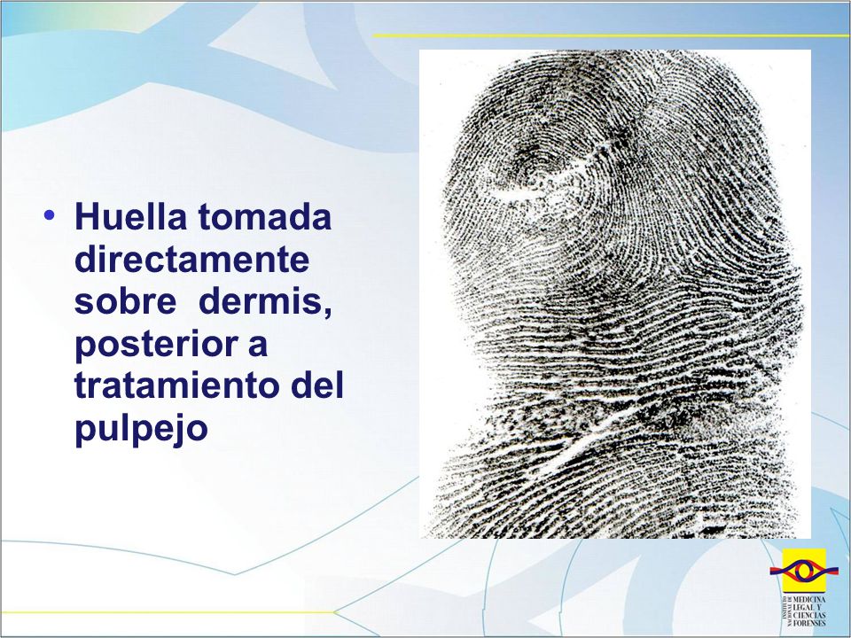 Huella tomada directamente sobre dermis, posterior a tratamiento del pulpejo