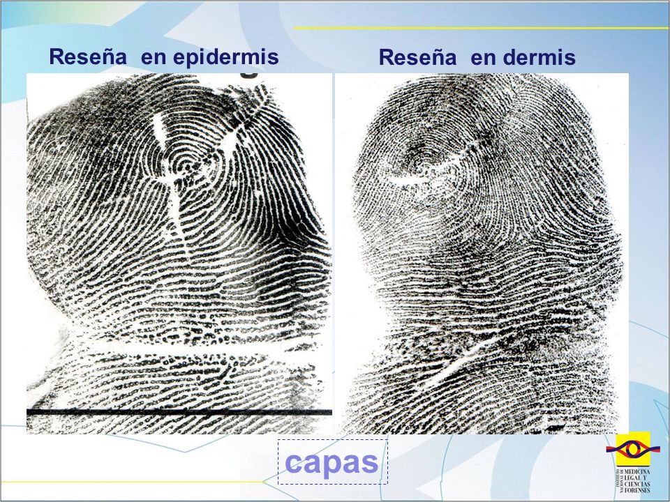 Reseña en epidermis Reseña en dermis capas