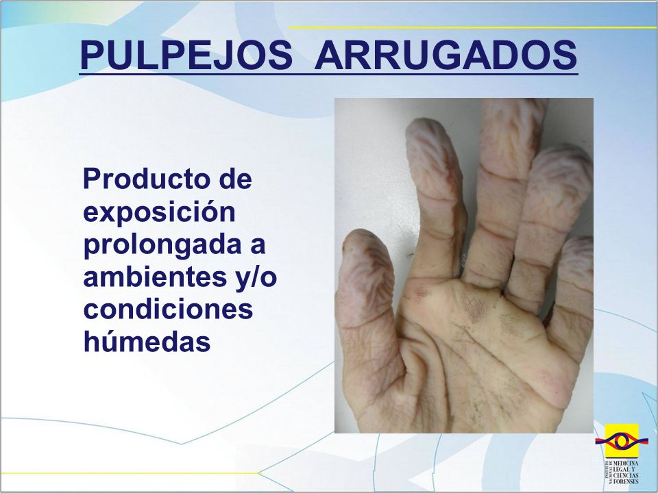 PULPEJOS ARRUGADOS Producto de exposición prolongada a ambientes y/o condiciones húmedas