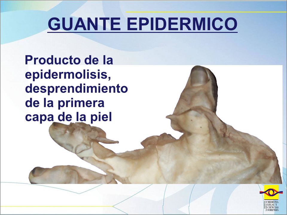 GUANTE EPIDERMICO Producto de la epidermolisis, desprendimiento de la primera capa de la piel