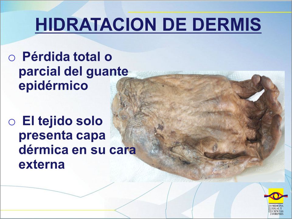HIDRATACION DE DERMIS Pérdida total o parcial del guante epidérmico