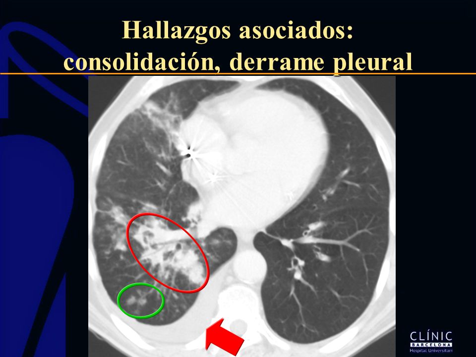 Hallazgos asociados: consolidación, derrame pleural
