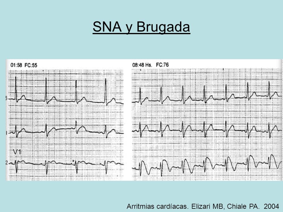SNA y Brugada V1 Arritmias cardíacas. Elizari MB, Chiale PA. 2004