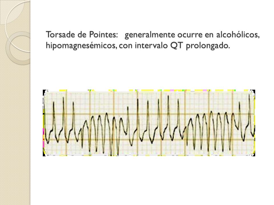 Torsade de Pointes: generalmente ocurre en alcohólicos, hipomagnesémicos, con intervalo QT prolongado.