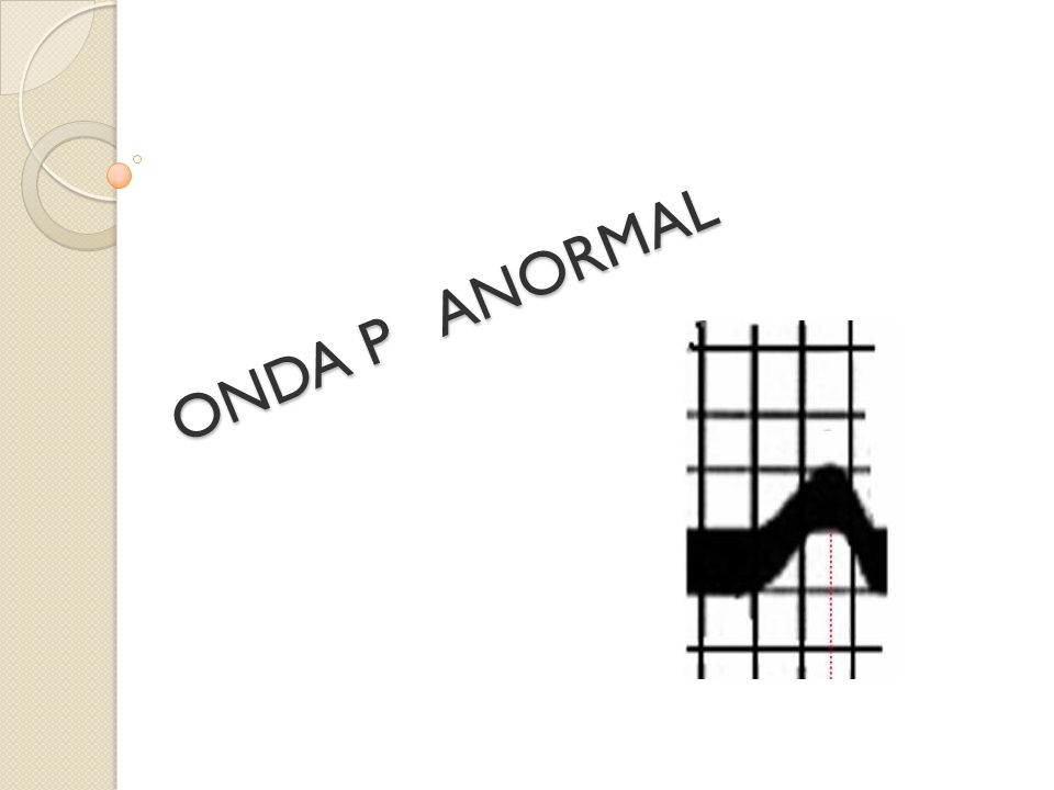 ONDA P ANORMAL