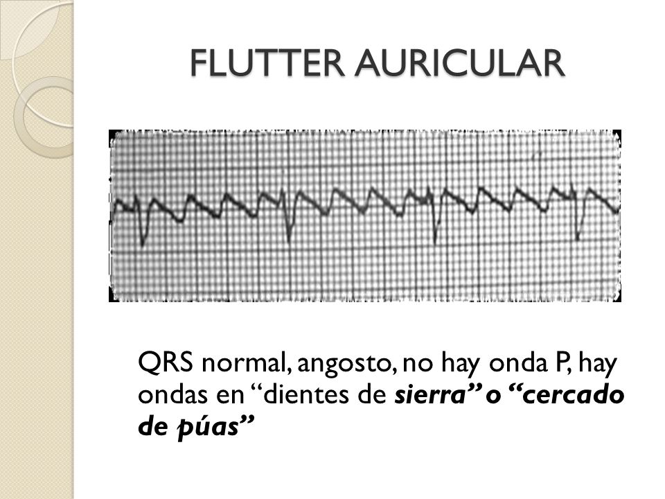 FLUTTER AURICULAR QRS normal, angosto, no hay onda P, hay ondas en dientes de sierra o cercado de púas