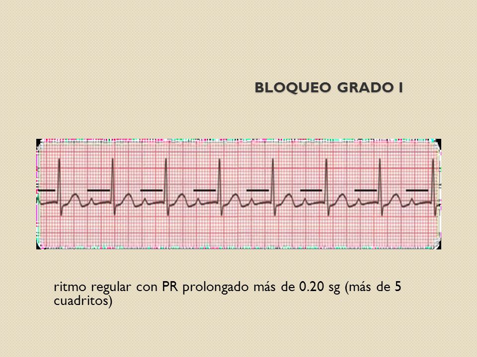 Bloqueo grado i ritmo regular con PR prolongado más de 0.20 sg (más de 5 cuadritos)