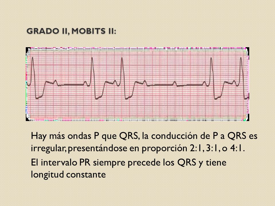 GRADO II, MOBITS II: Hay más ondas P que QRS, la conducción de P a QRS es irregular, presentándose en proporción 2:1, 3:1, o 4:1.