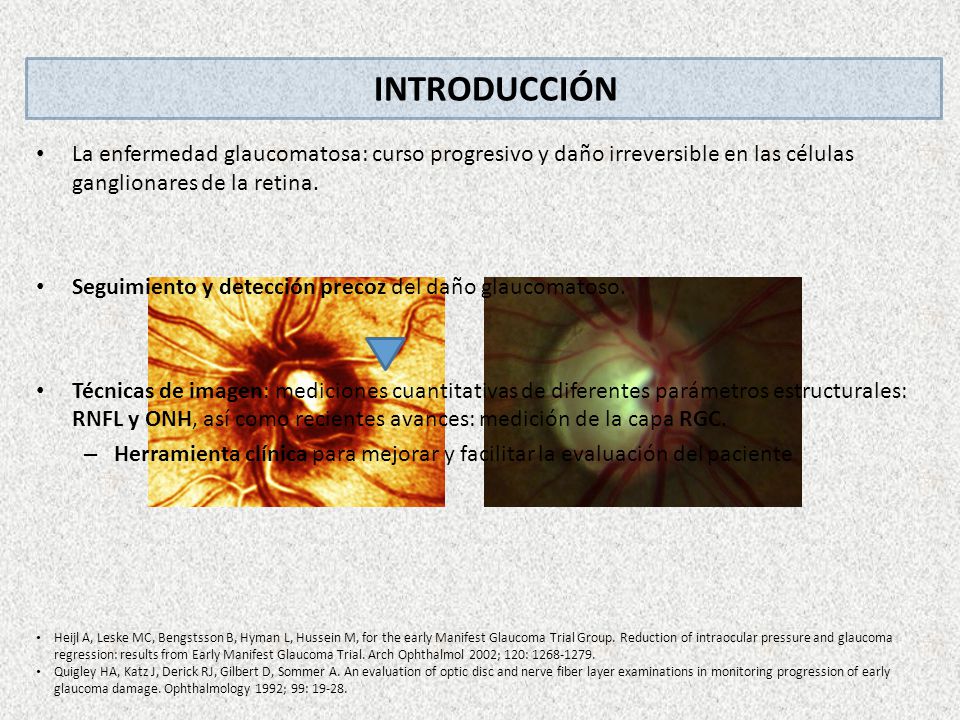 INTRODUCCIÓN La enfermedad glaucomatosa: curso progresivo y daño irreversible en las células ganglionares de la retina.